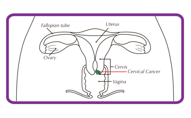 Cervical cancer_L